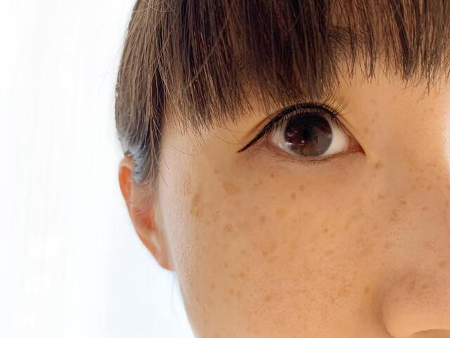 シミ・そばかすの基礎知識