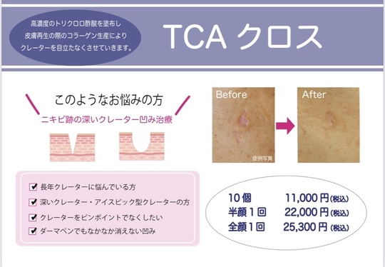 TCAクロス（ニキビ跡の凹み治療） - 韮崎市の皮膚科・美容皮膚科なら