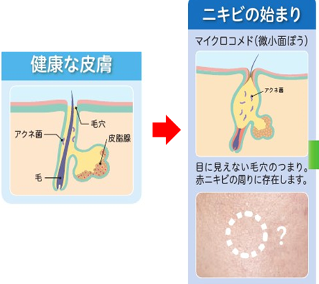 ニキビ ニキビ跡 保険 韮崎市の皮膚科 美容皮膚科ならさおり皮ふ科クリニック