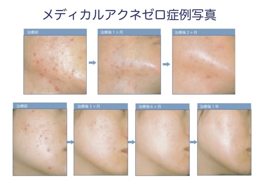 傷跡の治療、にきび治療に非常に効果的なアプリケーション 傷跡の治療