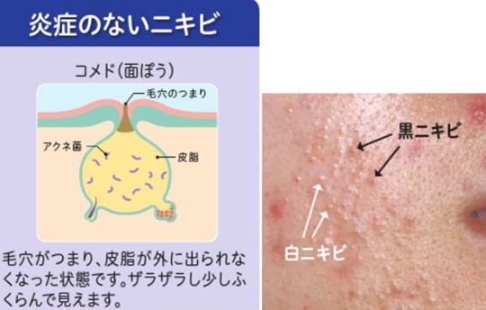 ニキビ ニキビ跡 保険 韮崎市の皮膚科 美容皮膚科ならさおり皮ふ科クリニック