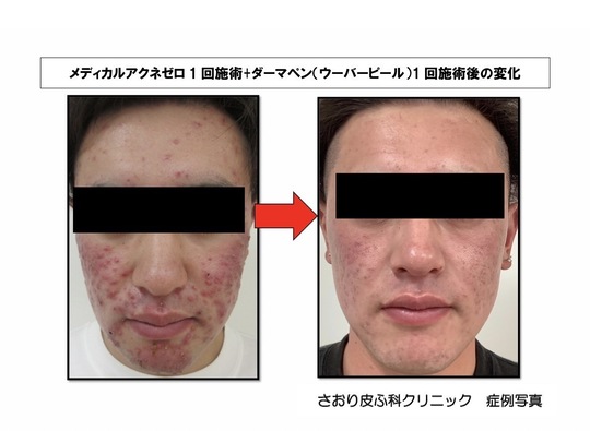 メディカルアクネゼロ - 韮崎市の皮膚科・美容皮膚科ならさおり皮ふ科