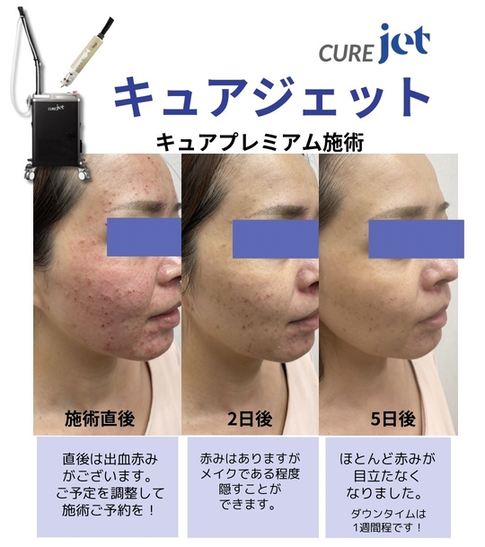 キュアジェット - 韮崎市の皮膚科・美容皮膚科ならさおり皮ふ科クリニック