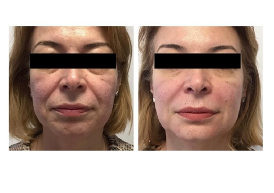 速攻リフト：スマスアップNEO - 韮崎市の皮膚科・美容皮膚科ならさおり